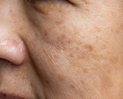 Pigmentation Treatment